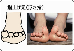 隠れている足の異常 浮き指 指上げ歩行 江戸川区瑞江駅から徒歩5分の整体あすなろ鍼灸整骨院